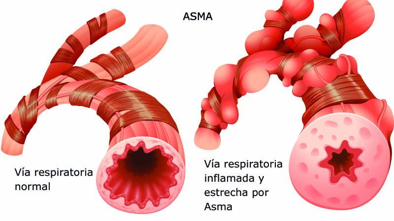Conozca más acerca del asma